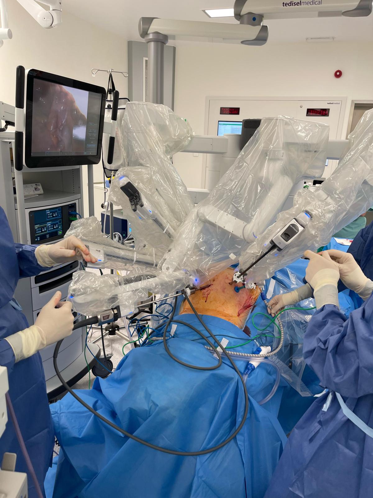 Clínic Lleida realitza la primera reconstrucció de bufeta amb cirurgia robòtica a Lleida