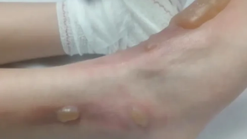 Cremades patides per en Joanathan durant el seu calvari